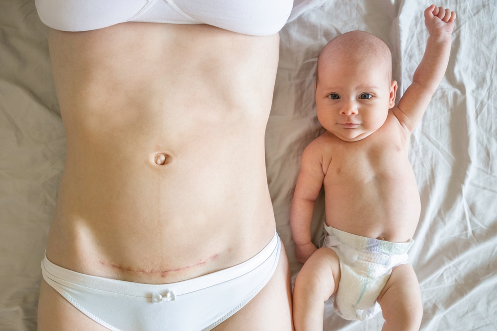 Cesarean Awareness Month woman with c-section scar and baby