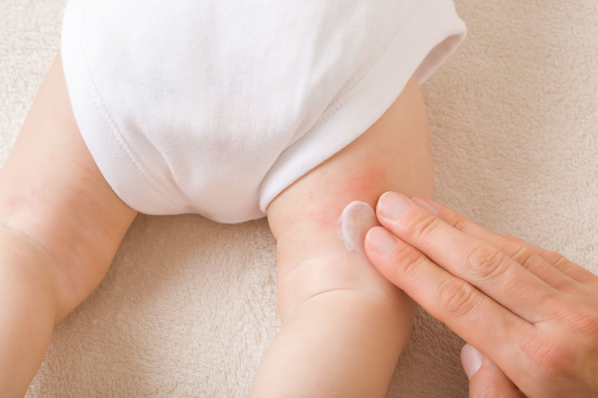 Recognizing and Managing Common Baby Allergies